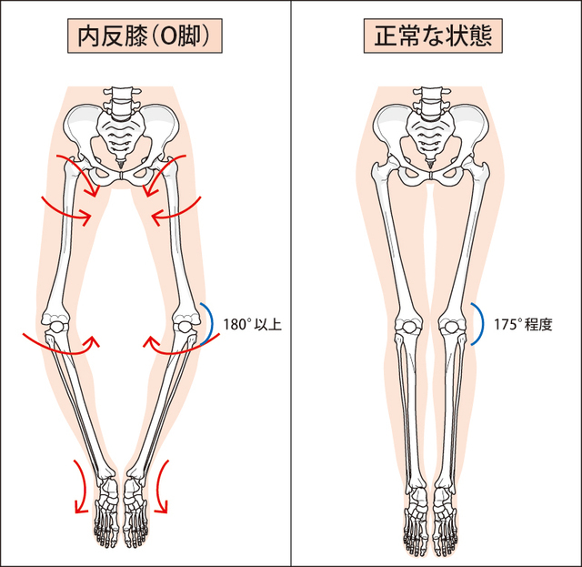 腸 脛 靱帯 炎